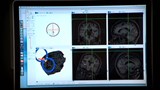 La stimulation transcrânienne : une nouvelle thérapie prometteuse
