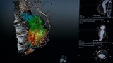 Voir l’aorte du cœur en 3D grace à un nouveau logiciel.