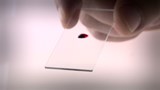 Dépister le cancer du sein dans une petite goutte de sang.